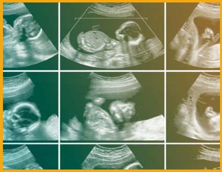 اسکن آنومالی