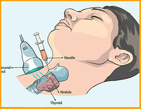 مرکز سونوگرافی و نمونه برداری ندول تیروئید در تهران