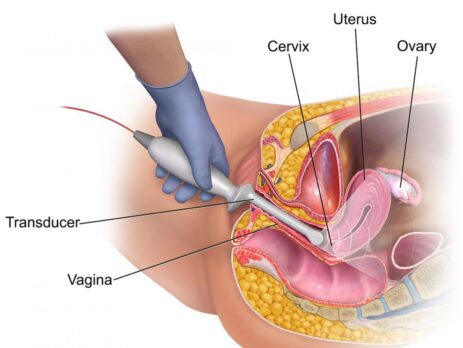 سونوگرافی اندومتریوز در مرکز سونوگرافی و رادیولوژی خورشید - شرق تهران