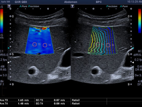 کبد یکی از حیاتیترین اندامهای بدن است که نقش مهمی در سمزدایی، متابولیسم داروها، ذخیره و آزادسازی انرژی و تولید پروتئینها دارد. هرگونه آسیب به کبد میتواند به بروز مشکلات جدی برای سلامت فرد منجر شود. در گذشته، بیوپسی کبد تنها روش قطعی برای تشخیص میزان آسیب یا فیبروز کبد بود، اما امروزه روشهای نوینی مانند فیبرواسکن یا الاستوگرافی کبد توانستهاند جایگزینی ایمن، سریع و غیرتهاجمی برای بررسی وضعیت کبد باشند.