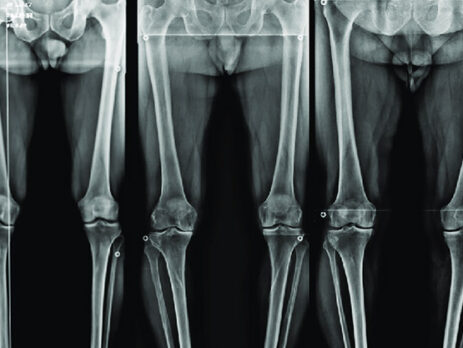رادیوگرافی سه‌ مفصلی (3-Joint Alignment View) در شرق تهران